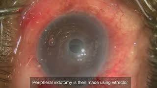 Descemet Membrane Endothelial Keratoplasty DMEK [upl. by Laural]