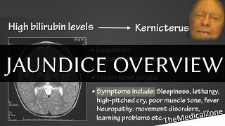 Jaundice Overview  Definition and Pathology Including neonatal jaundice [upl. by Ahsinek241]