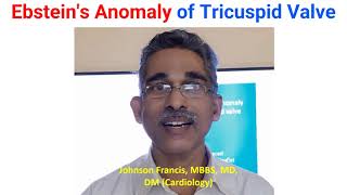 Ebsteins Anomaly of Tricuspid Valve [upl. by Yerd]