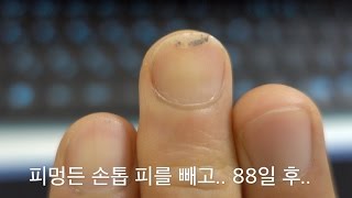 피멍든 손톱 피빼고  88일 후  Fingernail Bruise  After 88 days [upl. by Ginelle]