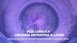 Como é feita a Cirurgia Refrativa a Laser para a correção da Miopia Hipermetropia e Astigmatismo [upl. by Gunther352]