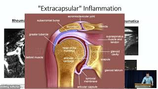 Polymyalgia Rheumatica What has changed since 1957 [upl. by Murvyn]