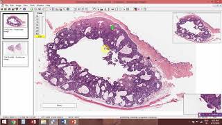 Trichofolliculoma [upl. by Acinorej218]