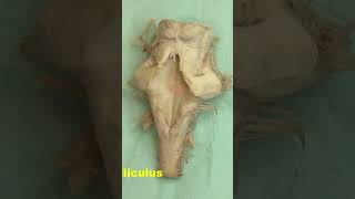 Facial colliculus Rhomboid fossa neuroanatomy brain brainstemrhomboidfossa [upl. by Dronel]