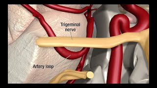 Treatment for Trigeminal Neuralgia UCSF Neurosurgery [upl. by Kola461]