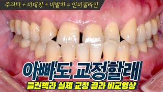 비발치교정 주걱턱교정 비수술 인비절라인 1년 6개월의 변화40대 50대 성인치아교정 교정 전후 후기 [upl. by Nauhs925]