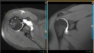 Labral tears and shoulder instability in twin brothers [upl. by Beniamino]