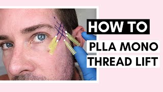 PLLA Mono Thread Lift On Temples  Technique Tips amp How To Insert Threads Ft Vanidiy [upl. by Berg350]