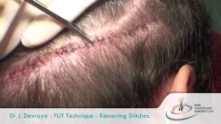 Dr DEVROYE  FUT Removing Stitches Trichophytic Closure Hair Transplant Tricho Closure Europe [upl. by Notnarb]