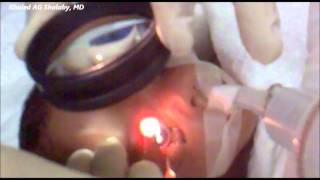 Laser Treatment of Retinopathy of prematurity ROP [upl. by Nazar520]