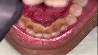 Limpieza de Sarro Dental Supragingival y Subgingival [upl. by Dloraj]