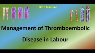 Management of Thromboembolic Disease in Labour [upl. by Dadelos]