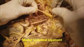 Pelvic Narrative Surgical Dissection  Iliac Artery Branches  Sanjoy Sanyal [upl. by Akcinehs]