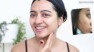 How to clear Acne Prone Skin Skin Care For Dull Acne Prone Skin [upl. by Imelida]