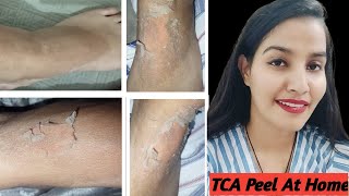 TCA Peel At Home  TCA Body Peel Before After  All Details tcapeel acnescars pigmention [upl. by Rosabelle]