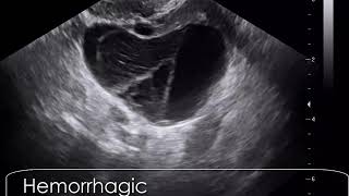 case 609 Hemorrhagic corpus luteum cyst CLC [upl. by Ecyoj913]