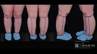 What is Lipedema [upl. by Lashonda]