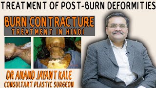 Burn Contracture and Deformities  जलने पर त्वचा चिपकने की समस्या का इलाज  Dr Anand Jayant Kale [upl. by Noir]