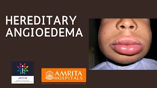 Hereditary Angioedema  C1 Esterase Deficiency [upl. by Derek]