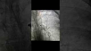 Pulmonary Embolism Thrombectomy [upl. by Profant559]