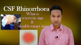 CSF Rhinorrhoea or Cerebrospinal Fluid Leak through Nose Signs Symptoms Diagnosis amp Treatment [upl. by Aihceyt276]