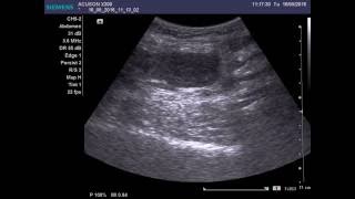 Liposarcoma of soft tissues [upl. by Dnomad]