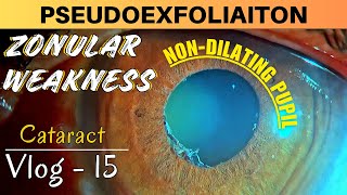 Small pupil PhacoemulsificationPseudoexfoliation BHEX ring amp CTR insertion  Dr Deepak megur [upl. by Idahs381]