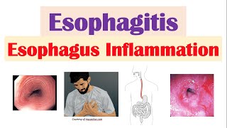 Esophagitis Esophagus Inflammation Causes Risk Factors Signs and Symptoms Diagnosis Treatment [upl. by Ranip]