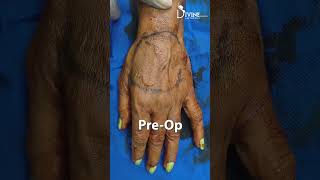 Hand Fat Grafting Pre and Post  Hand Rejuvenation Before amp After with Fat Transfer [upl. by Kirven]