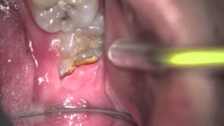 Wisdom Teeth need extraction for various reasons [upl. by Niveb688]