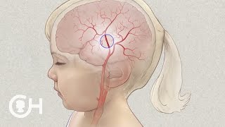 Moyamoya Disease Surgery for Children Pial Synangiosis [upl. by Pinelli]