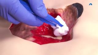 How to Effectively Cleanse and Debride a Wound  Wound Cleansing and Debridement  Ausmed Education [upl. by Anahsal]