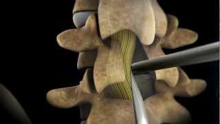 TLIF Transforaminial Lumbar Interbody Fusion  Larry Parker MD [upl. by Ahsinom869]