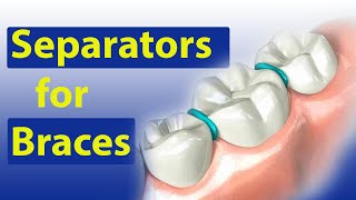 Separators Spacers for Braces  Braces Guide [upl. by Ahsimit]