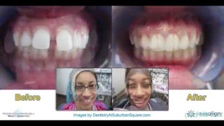 Invisalign Before amp After Slideshow [upl. by Otreblaug]