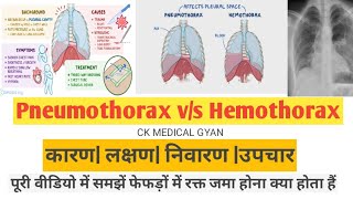 hemothorax vs pneumothorax क्या होता है फेफड़ों में रक्त जमा होने से कैंसर हो सकता है [upl. by Sheeree]