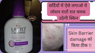 lacto calamine face lotion lacto calamine lotion for acne prone skin reviewlacto calamine lotion [upl. by Nedla]