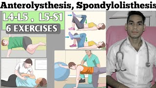 Anterolisthesis spondylolisthesis l4 L5s1 exercise treatment Low back pain exercises Disc bulged [upl. by Colin275]