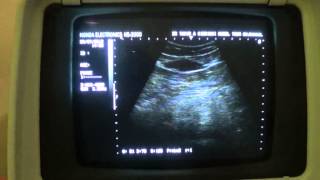 ultrasound FATTY PANCREAS [upl. by Aromat]