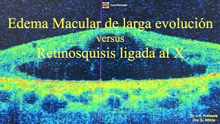 Edema Macular de larga evolución vs Retinosquisis ligada al X [upl. by Etnahs]