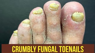 SUPER SATISFYING FUNGAL TOENAIL CLEANING BRING THE PILLOWS [upl. by Komara791]