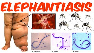 Lymphatic Filariasis  Elephantiasis [upl. by Selyn]