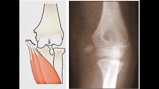 Displaced Medial epicondyle Fracture in ChildORIF [upl. by Pepillo]