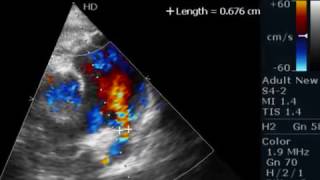 PDA  ECHOCARDIOGRAPHY SERIES BY DR ANKUR K CHAUDHARI [upl. by Garibull]