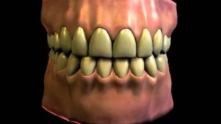 Dental Bruxism Teeth Grinding [upl. by Geri698]