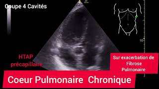 Coeur Pulmonaire Chronique HTAP Précapillaire Échographie [upl. by Attaymik]