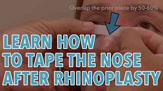 Rhinoplasty Taping [upl. by Yllrebmik948]