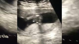 posterior placenta and Baby boy DrRimshaBaby boy om ultrasound [upl. by Idnim]