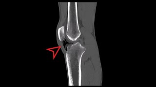 Knee CT Laceration with Traumatic Arthrotomy [upl. by Repsaj]