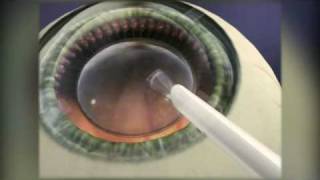 Implantable Contact Lens [upl. by Annenn]